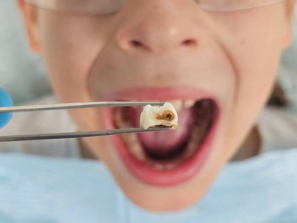 Best Root Canal Emergency Dentist  in Trenton, IL